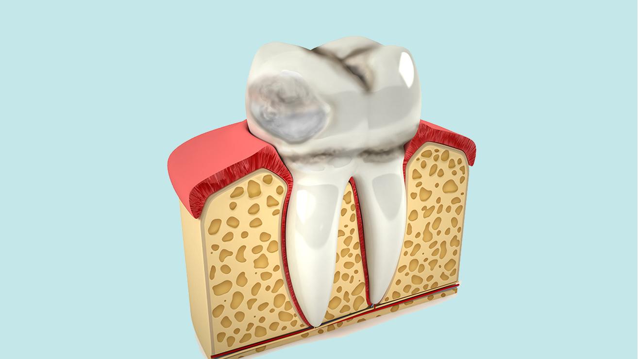 Dents in teeth image