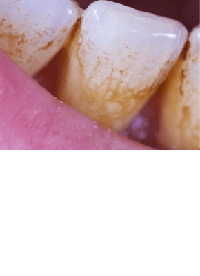 Teeth covered in plaque