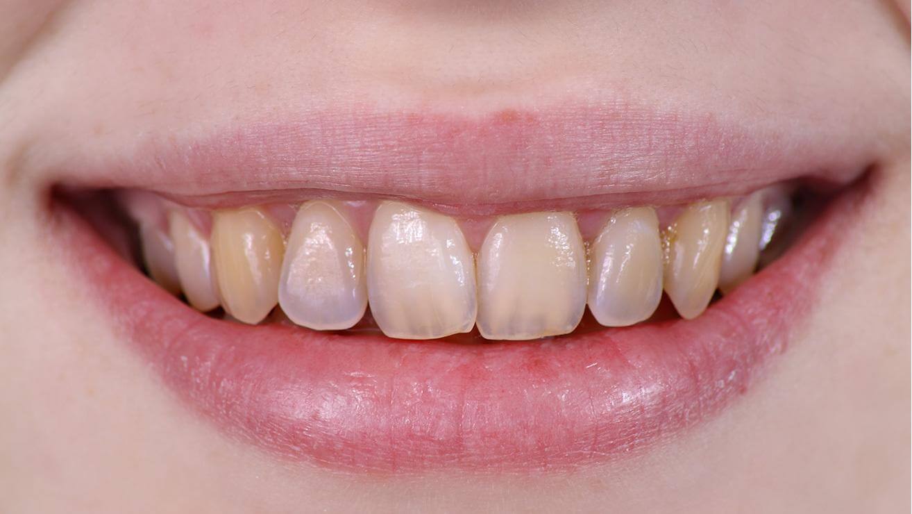 yellowish teeth image